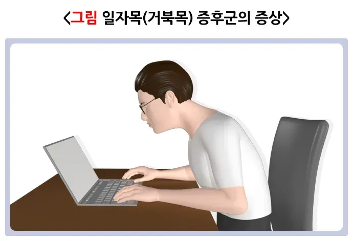 일자목(거북목)증후군 정의 설명 이미지 1