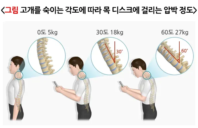 일자목(거북목)증후군 병태생리 설명 이미지 1