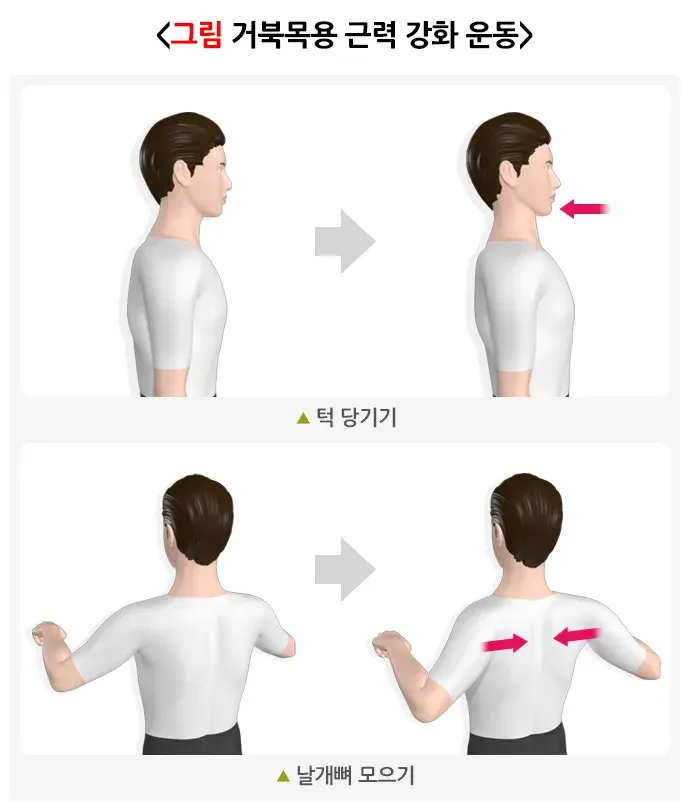일자목(거북목)증후군 비약물 치료 설명 이미지 2