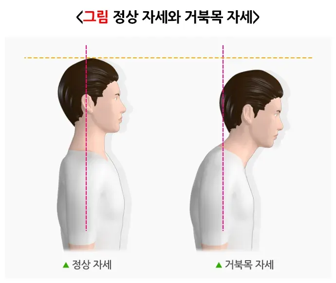 일자목(거북목)증후군 진단 및 검사 설명 이미지 1