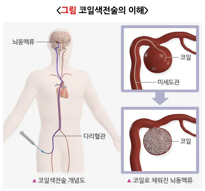 뇌동맥류 치료 설명 이미지 3