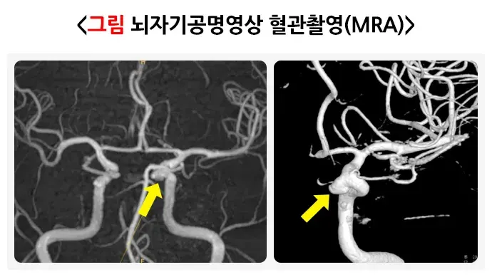 뇌동맥류 진단 및 검사 설명 이미지 3