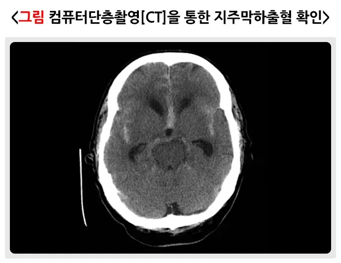 뇌동맥류 진단 및 검사 설명 이미지 1