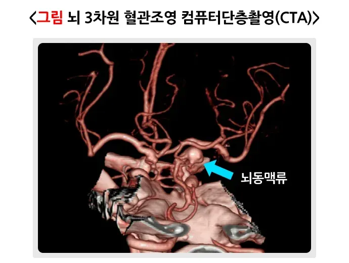 뇌동맥류 진단 및 검사 설명 이미지 2