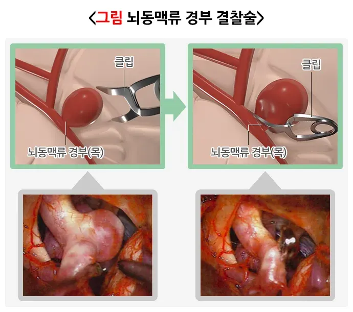 뇌동맥류 치료 설명 이미지 1