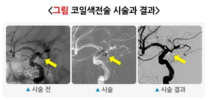뇌동맥류 치료 설명 이미지 2