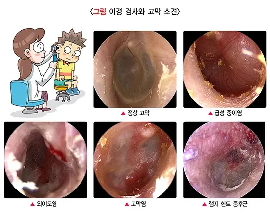 귀의 통증 및 분비물 진단 및 검사 설명 이미지 1