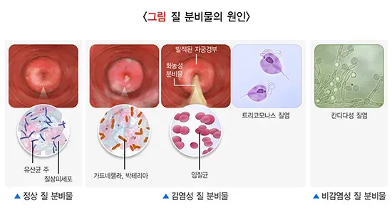 질분비물 원인 설명 이미지 1