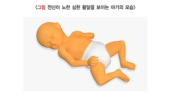 신생아 황달 정의 설명 이미지 1