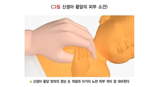 신생아 황달 진단 및 검사 설명 이미지 1