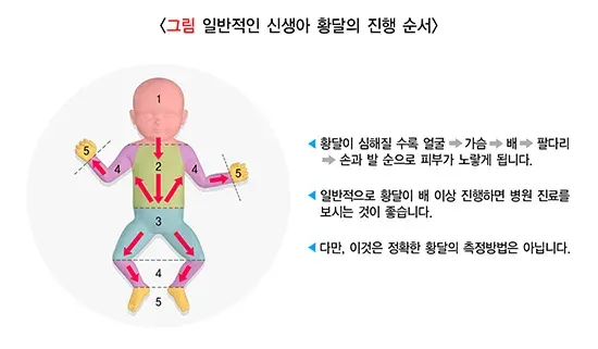 신생아 황달 진단 및 검사 설명 이미지 2