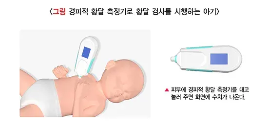 신생아 황달 진단 및 검사 설명 이미지 5