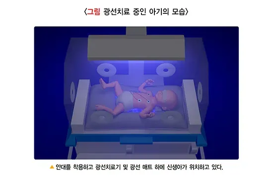 신생아 황달 치료 설명 이미지 1