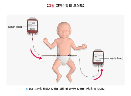 신생아 황달 치료 설명 이미지 2
