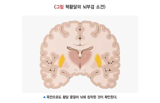신생아 황달 합병증 설명 이미지 1