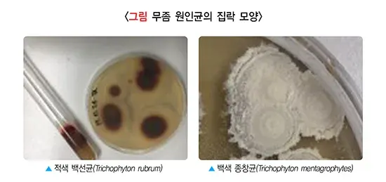 발 백선(무좀) 원인 설명 이미지 1
