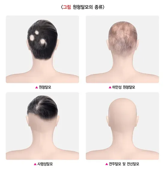 원형탈모 종류 설명 이미지 1