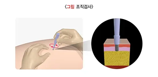 습진 진단 및 검사 설명 이미지 2