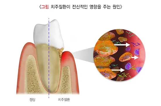 전신질환과 치주치료 원인 설명 이미지 1