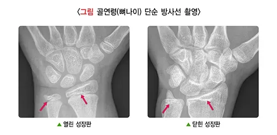 성장장애 진단 및 검사 설명 이미지 2