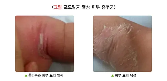 소아발진 관련 질환 설명 이미지 1