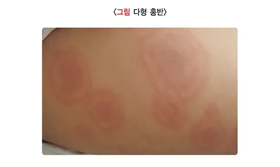 소아발진 관련 질환 설명 이미지 2