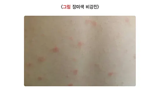 소아발진 관련 질환 설명 이미지 3