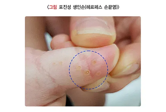 소아발진 관련 질환 설명 이미지 4