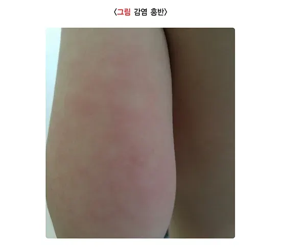 소아발진 관련 질환 설명 이미지 5