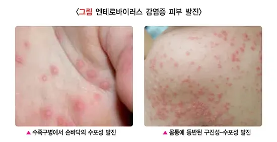 소아발진 관련 질환 설명 이미지 6