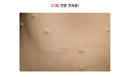 소아발진 관련 질환 설명 이미지 7