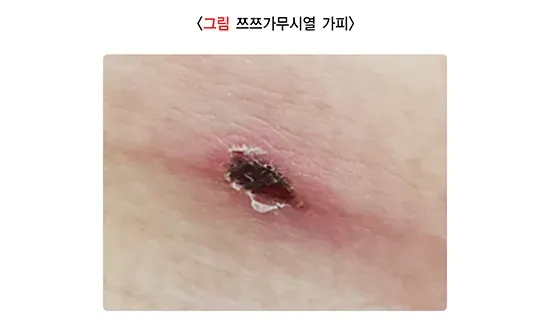 소아발진 관련 질환 설명 이미지 8