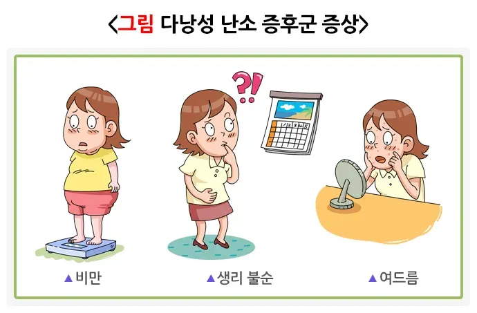 다낭성난소증후군 증상 설명 이미지 1