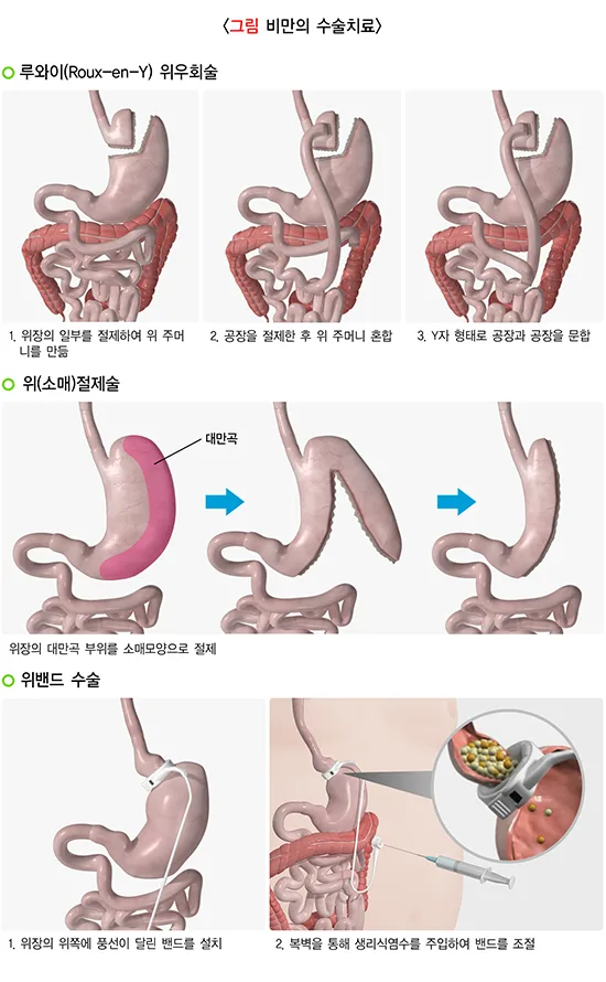 비만 일반적 실천 방법 설명 이미지 1