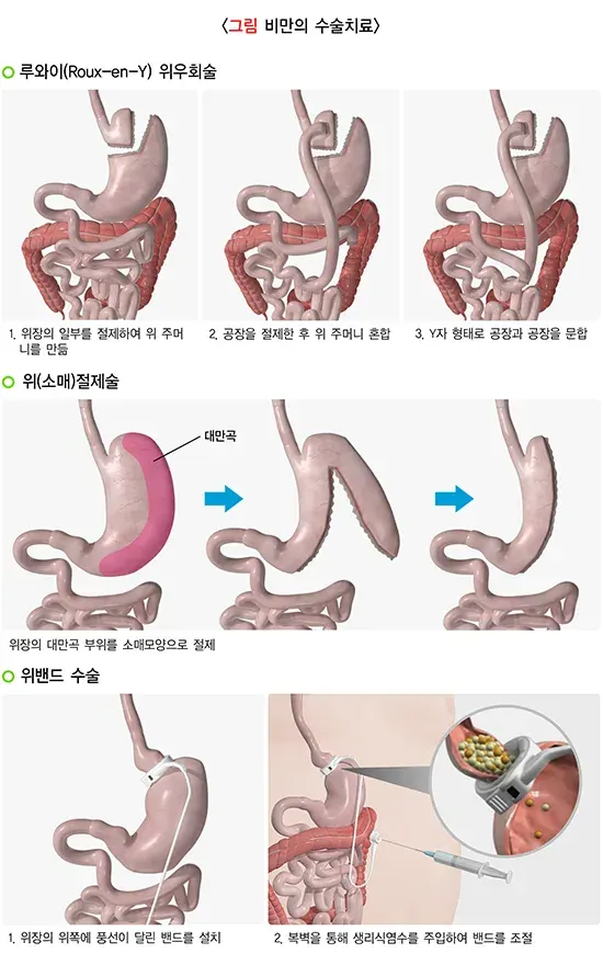 비만 일반적 실천 방법 설명 이미지 1