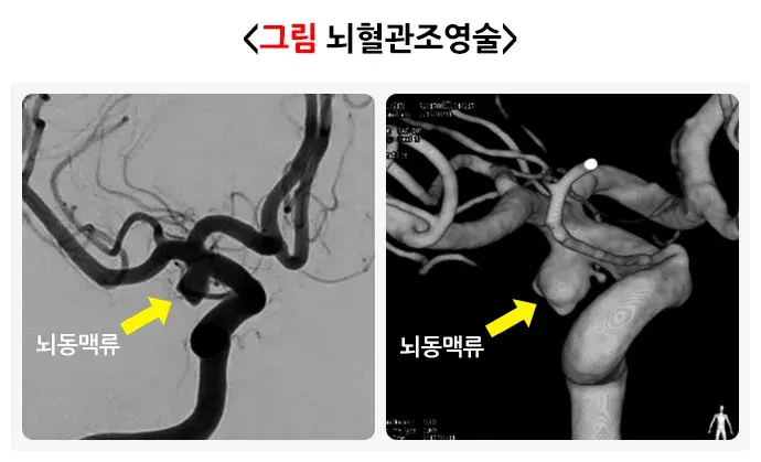 뇌동맥류 진단 및 검사 설명 이미지 4