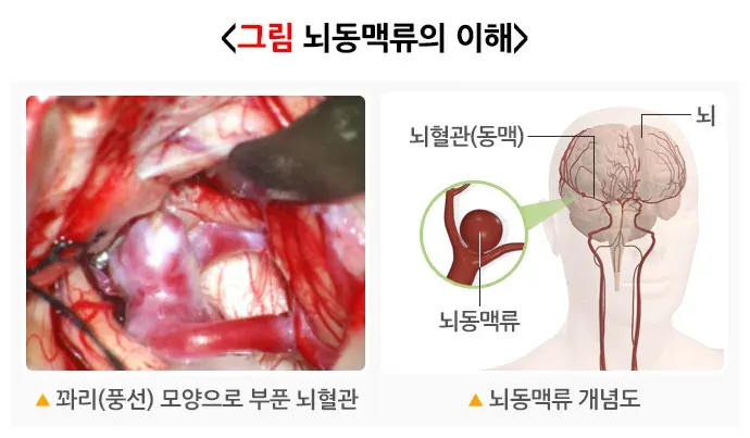 뇌동맥류 정의 설명 이미지 1
