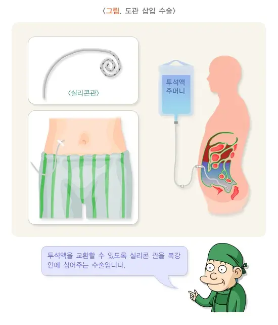 복막투석 치료 방법 설명 이미지 3
