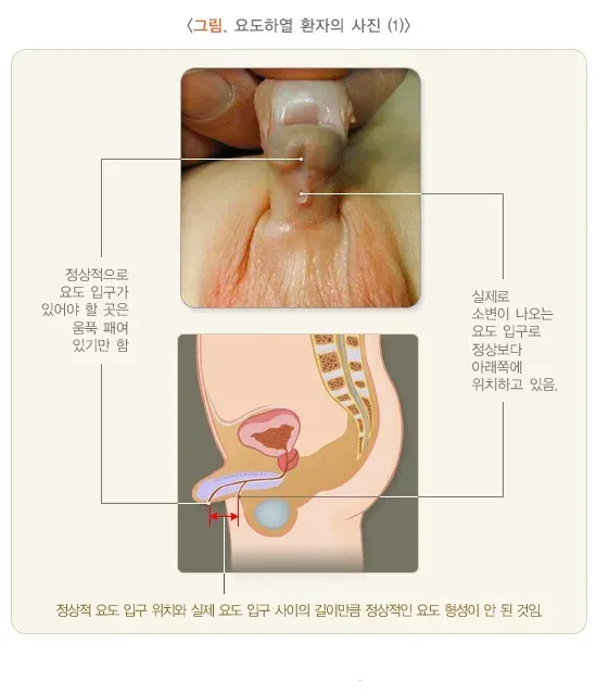 요도하열(소아) 정의 설명 이미지 1