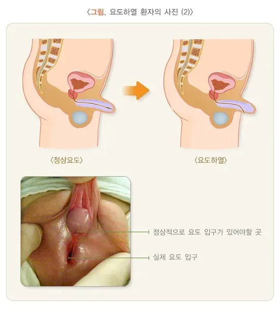 요도하열(소아) 정의 설명 이미지 2