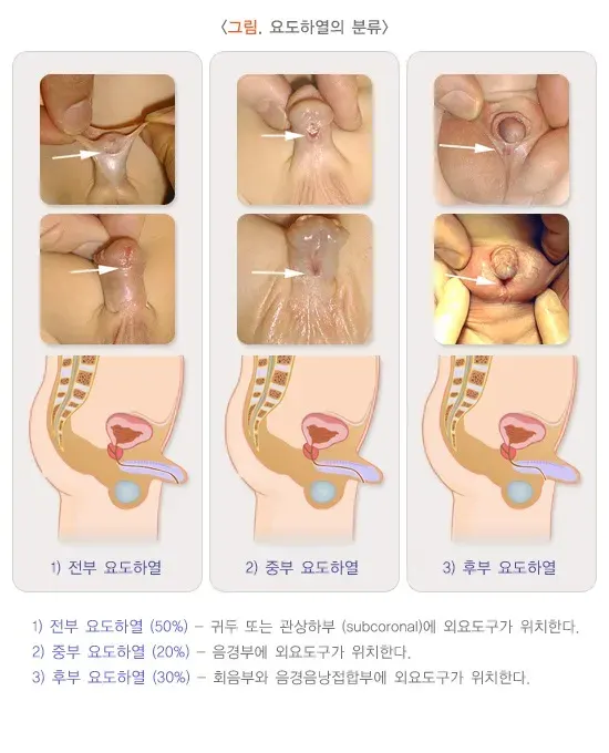 요도하열(소아) 종류 설명 이미지 1
