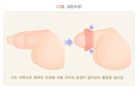 포경수술 치료의 적응증 설명 이미지 2