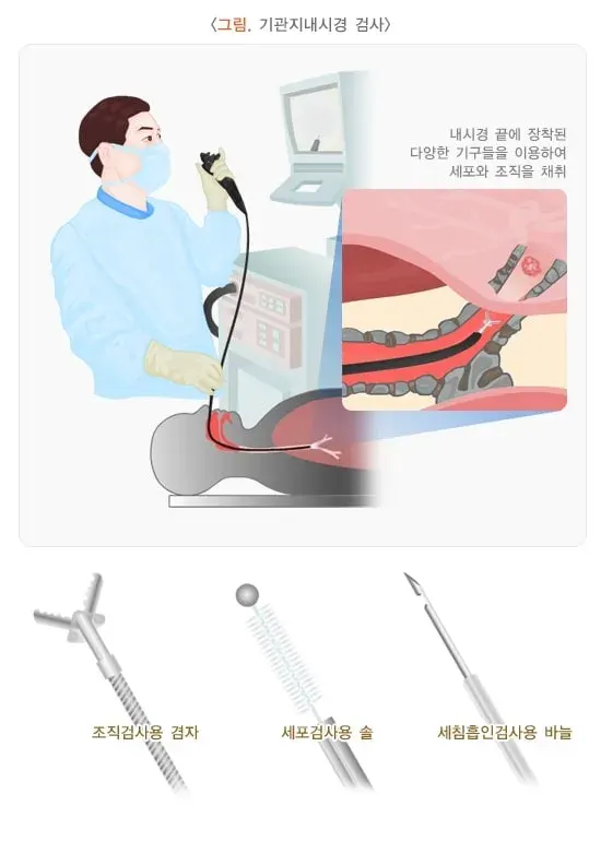 기관지 내시경 검사 검사 항목 설명 이미지 1
