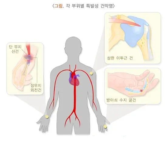 건막염 종류 설명 이미지 1