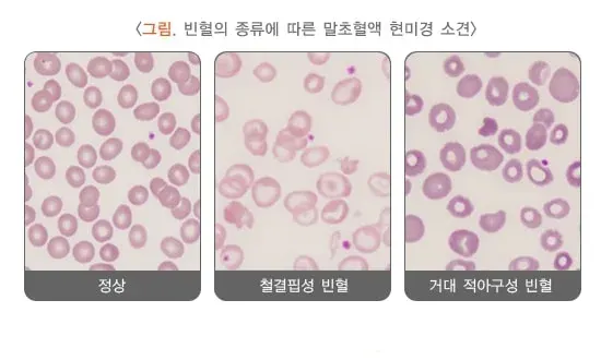 빈혈 진단 및 검사 설명 이미지 1