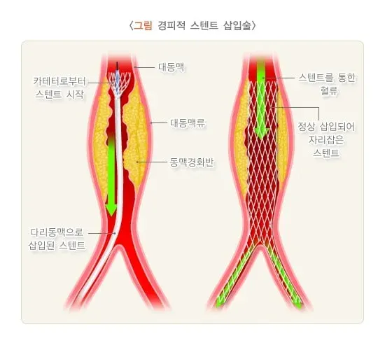 대동맥류 비약물 치료 설명 이미지 2