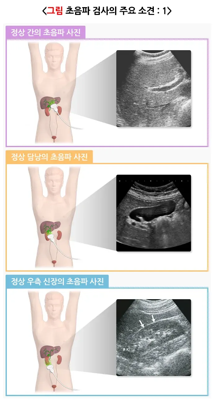 복부초음파검사 검사 결과 해석 설명 이미지 1