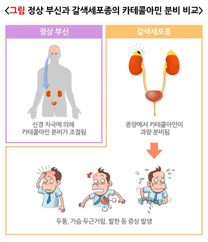 갈색세포종 증상 설명 이미지 1
