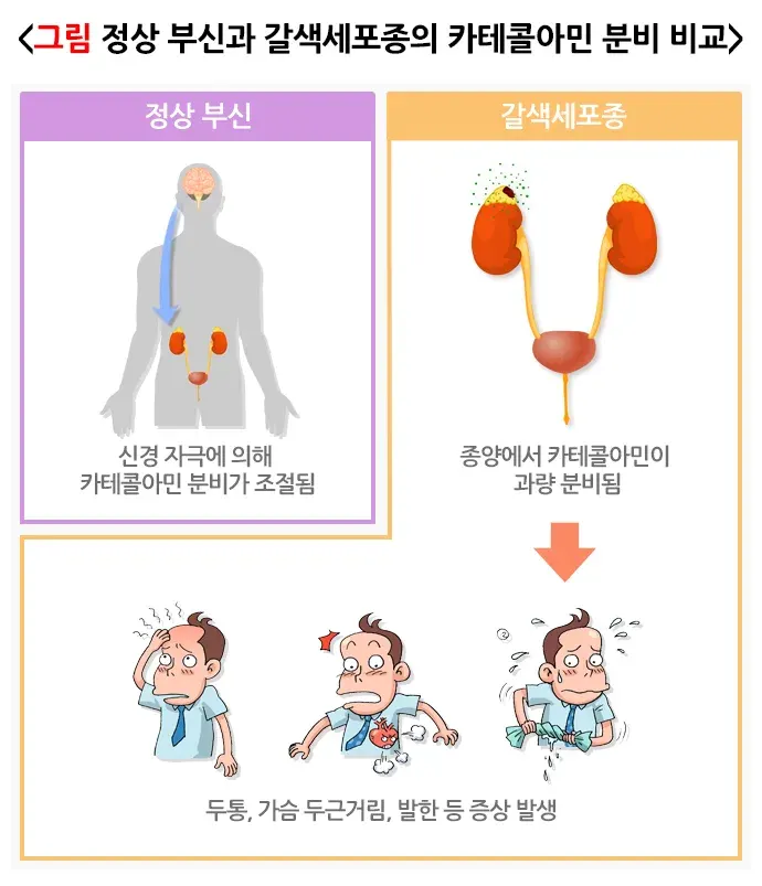 갈색세포종 증상 설명 이미지 1