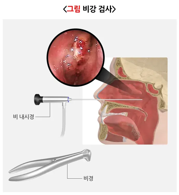 비부비동염 진단 및 검사 설명 이미지 2